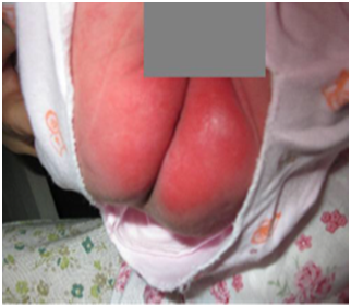 新生儿尿布皮炎防治