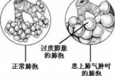 肺气肿预防保健